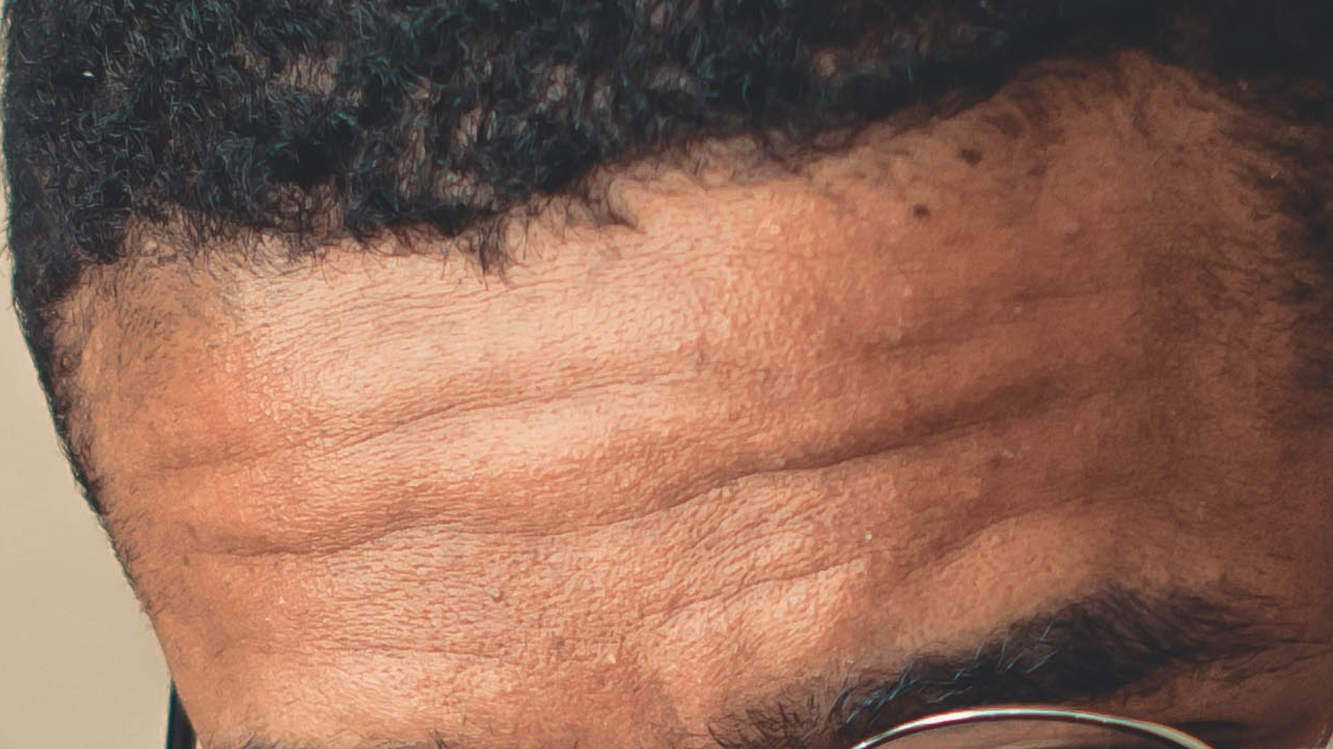 Close-up view of a forehead showing skin texture and hairline with glasses partially visible.
