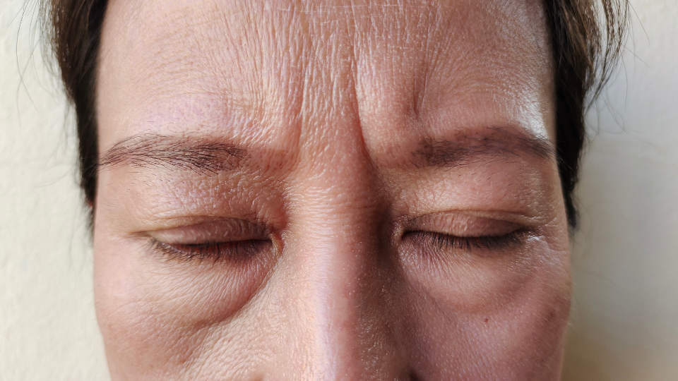 Close-up of a forehead showing deep frown lines and wrinkles, highlighting cosmetic injectable options such as BOTOX, Dysport and Jeuveau